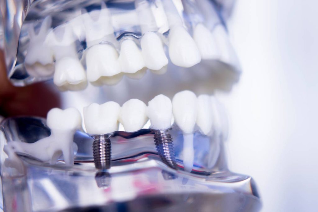 Implanty zębów w Szczecinie
